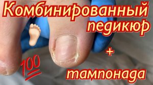 Комбинированный педикюр ??? + тампонада???
