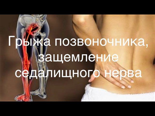 ГРЫЖА ПОЗВОНОЧНИКА / ЗАЩЕМЛЕНИЕ СЕДАЛИЩНОГО НЕРВА / КАК Я ЛЕЧИЛАСЬ / ОПЕРАЦИЯ / МОЙ РАССКАЗ