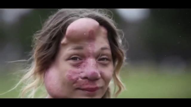 Доктора отрезали девушке нос, чтобы спасти ее. Вы улыбнетесь, когда увидите, как она выглядит смотреть онлайн