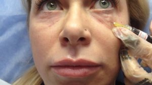 АирисКом студенты учатся: Филлеры. Заполнение морщин гиалуроновой кислотой область вокруг глаз.