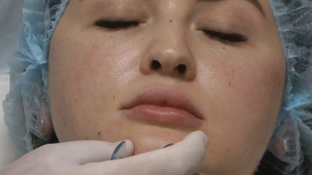 Контурная пластика средней и нижней трети лица. Воркшоп Dr.Valeriy Potiy