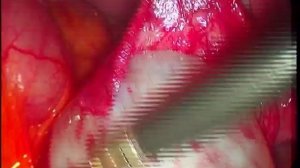 Paraovarian cyst. Параовариальная киста  Лапароскопия