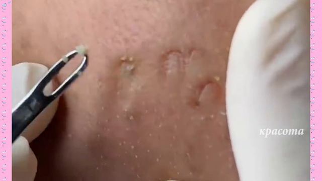 Как Избавиться от Угрей Раз и Навсегда #04 смотреть онлайн