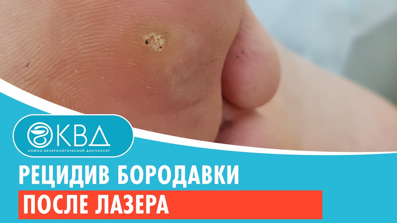 ? Рецидив бородавки после лазера. Клинический случай №216