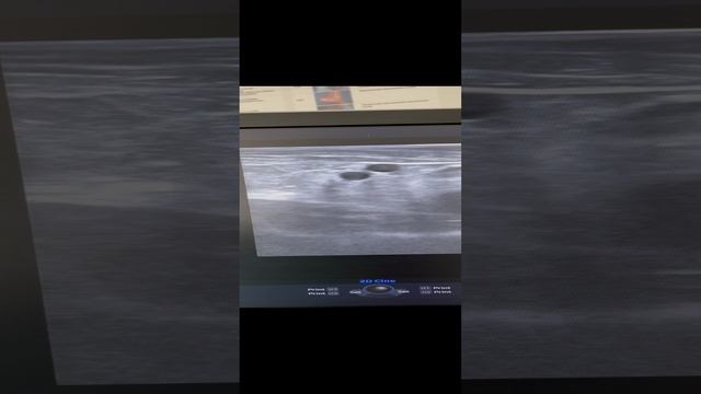 Узи при тазовом варикозе. Как лечить варикоз? Узи вен. Флеболог Москва. Флеболог. Сосудистый хирург смотреть онлайн