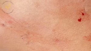 Acne Treament Under The Skin #039