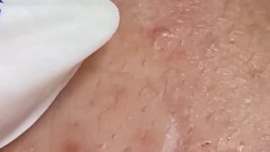 Relax squeezing out blackheads #43 Черные точки