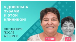 После имплантации всех зубов по протоколу all-on-6