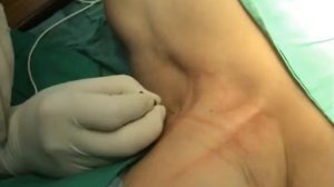 Блокада плечевого сплетения (межлестничный доступ)