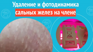 ✅ Удаление и фотодинамика сальных желез на члене. Клинический случай №1131