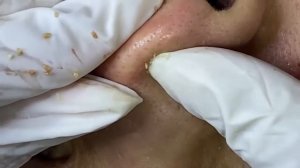 Relaxing Acne Treatment Acnes Treatment  78