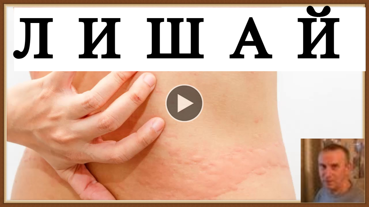 ЛИШАЙ - ВИДЫ СИМПТОМЫ