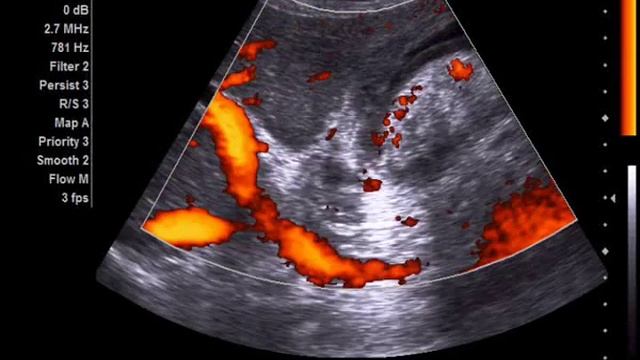 Гигантский холестериновый камень желчного пузыря. смотреть онлайн