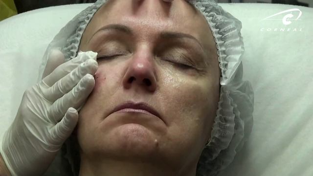 Коррекция переорбитальной области смотреть онлайн