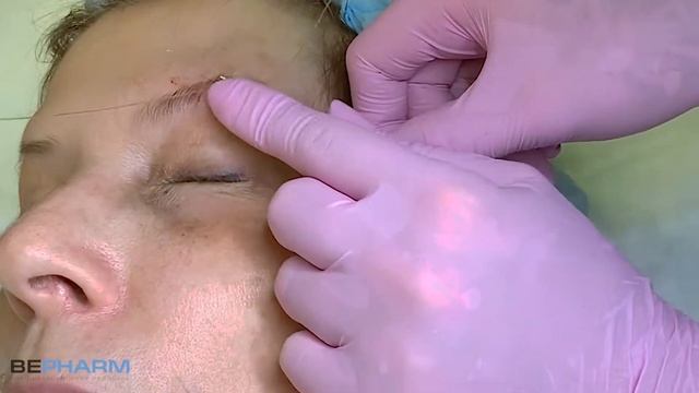 Лифтинг бровей с помощью нитей с насечками