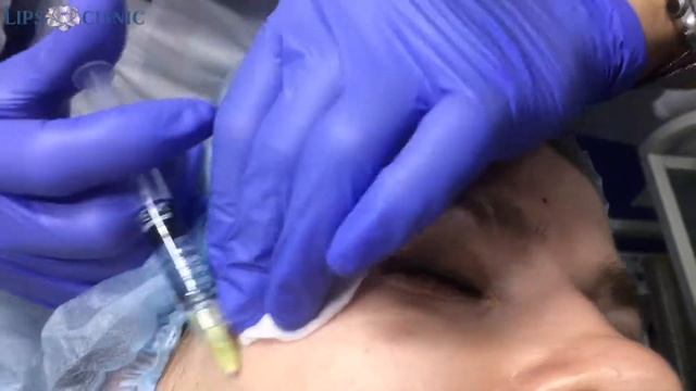 Биоревитализация иал систем смотреть онлайн