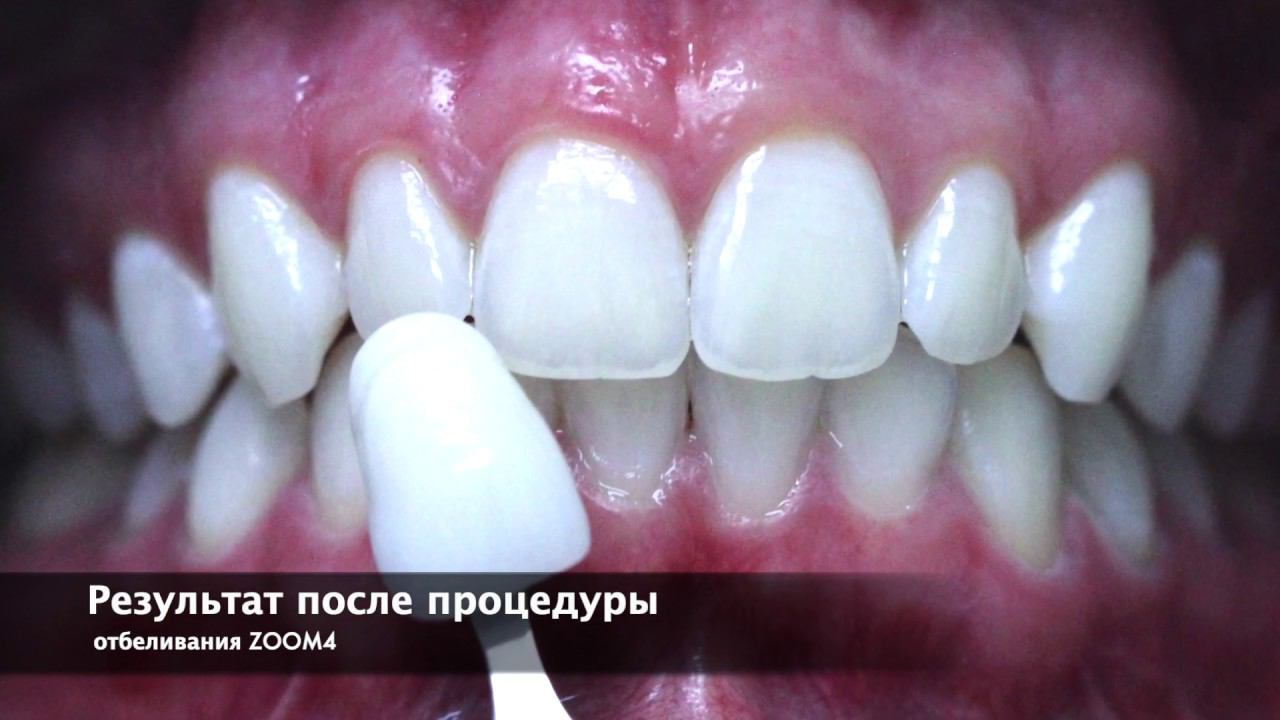 Отбеливание зубов Philips Zoom! White Speed (Zoom4)
