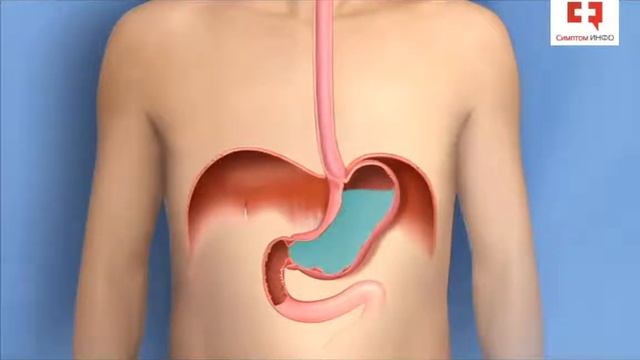 Изжога после еды и ее причины_ гастроэзофагеальная рефлюксная болезнь (ГЭРБ) и рефлюкс эзофагит