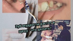 Зуб мудрости растет в щеку - что делать?