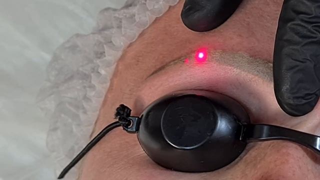 Лазерное удаление татуажа бровей смотреть онлайн