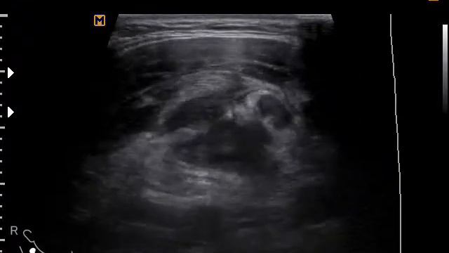 Боковая киста шеи (20-9-171) смотреть онлайн