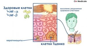 Вирус ветряной оспы (ветрянка и опоясывающий лишай) - клиника, диагностика, лечение