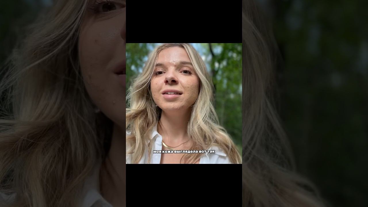 до/после спустя 8 месяцев #ретиноиды #акне #лечениекожи смотреть онлайн