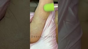 Как быстро убрать трещины на пятках и подушечках пальцев