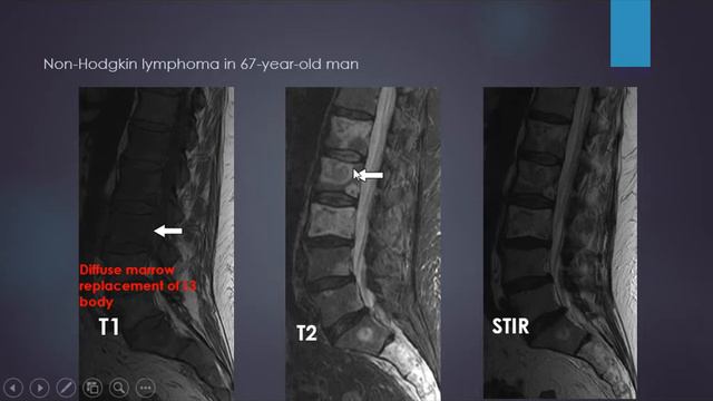 Halo sign, bone marrow features on MRI смотреть онлайн
