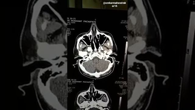 CT PNS (Paranasal Sinuses)/What is PNS /Anatomy/Treatment/Tablets/ENT Treatment/@omkarmahendrakar16