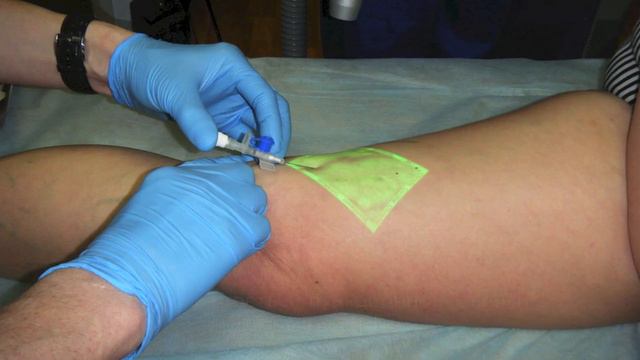 Криосклеротерапия - новая методика склеротерапии