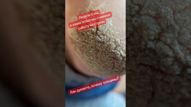 😱Огромная бородавка #трещинынапятках с сюрпризом, #подологмосква #подология смотреть онлайн