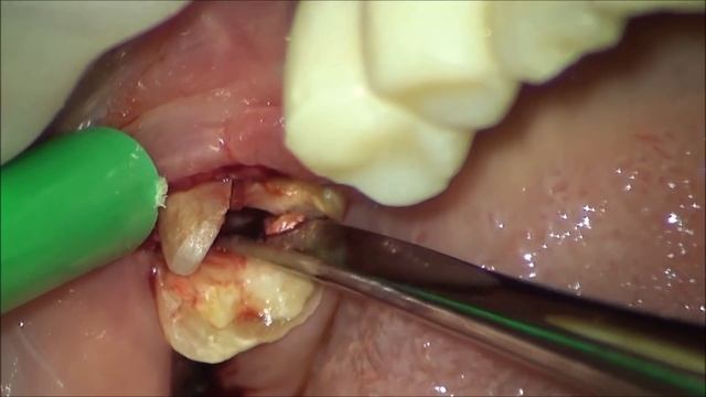 Атравматичное удаление зуба. Dr. Amiyanc. Stavropol City. Clinika DA Vinci.
