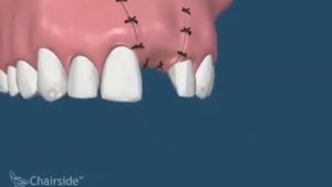 Установка импланта