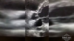 ЭНДОКАРДИТ АОРТАЛЬНОГО КЛАПАНА