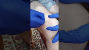 профилактика гоноартроза. хиджама на колени.