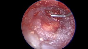 передняя перфорация хрящевая тимпанопластика адаптация положения хряща вторым хрящом