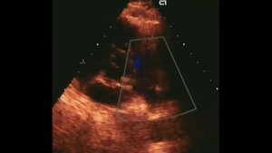 Коронарно -легочная фистула