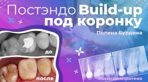 Постэндо l Build-up под коронку