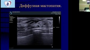УЗД Молочных желез ч1 Болоцков А С