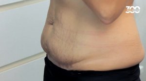 Пластика живота и груди за 1 операцию.