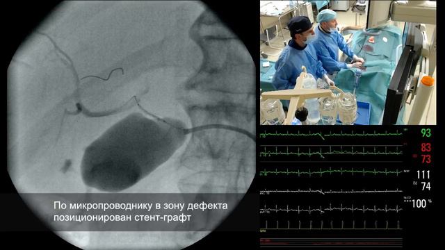 Закрытие дефекта общей печеночной артерии. смотреть онлайн