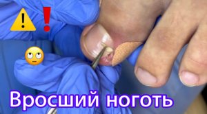 Вросший ноготь?⚠️❗️??