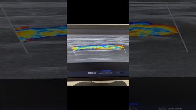 Атеросклероз сосудов. Как лечить атеросклероз? Снизить холестерин. Сосудистый хирург. Узи сосудов смотреть онлайн