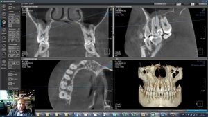 Наклонная проекция в OnDemand3D Dental