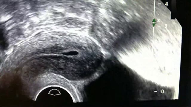 полип эндометрия (endometrial polyp) и серозометра (serozometer)