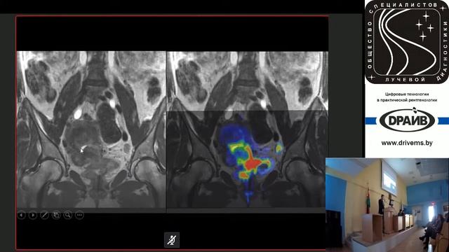 Современные аспекты МР-сканирования и диагностики опухолевых поражений органов женского малого таза смотреть онлайн