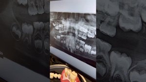 Панорамный снимок зубов у детей в Сочи, ОПТГ, ортопантомограмма