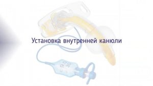 Установка внутренних канюль в трахеостомические трубки производства «Portex», «Ютипадо»