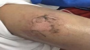 Смартфон взорвался в кармане у ребенка